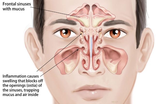 [Image: how-to-relieve-sinus-pressure-1.jpg]