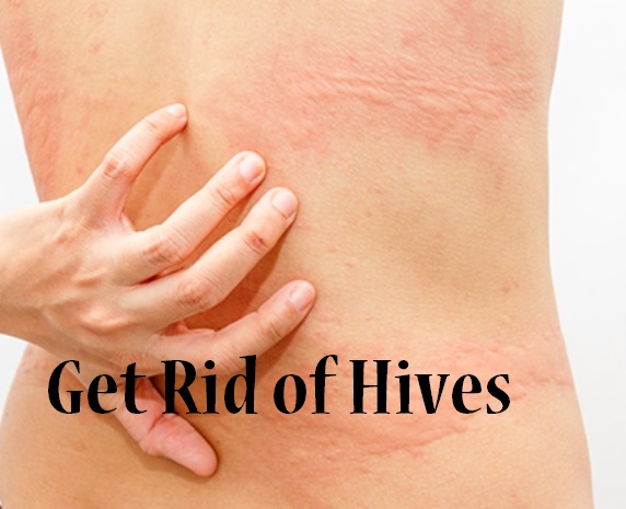 severe-case-of-hives-health-and-fitness-pinterest-doctors