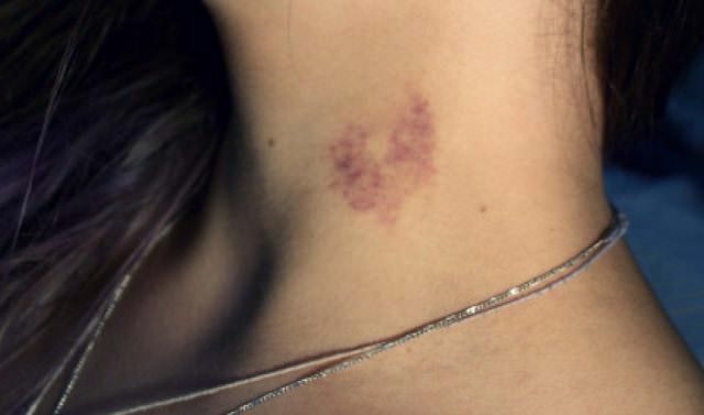 How To Get Rid Of Hickeys Fast