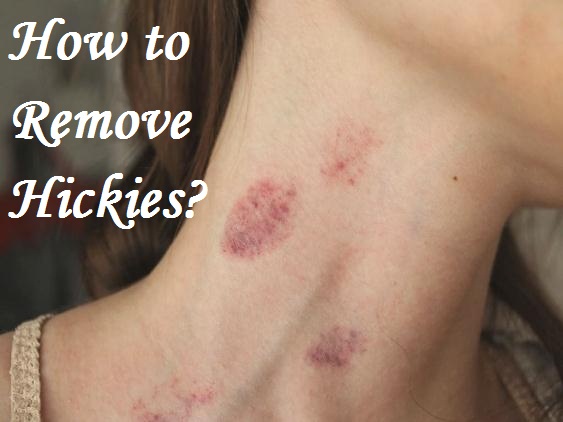 How To Remove Hickies 