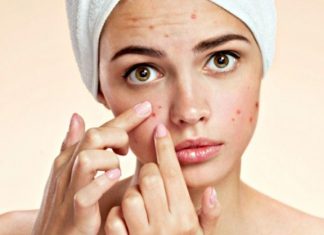 Home Remedies for Pimples