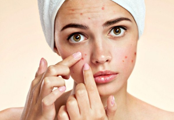 Home Remedies for Pimples