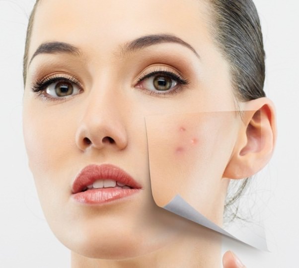 How to Get Rid Pimples Overnight