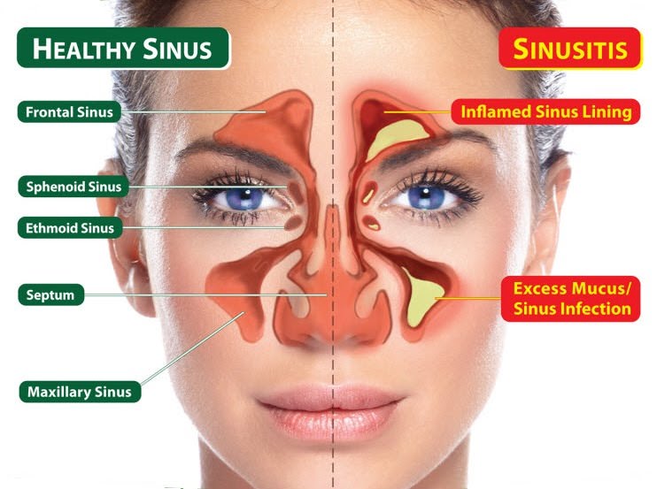 How to clear sinuses