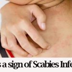 home remedies for scabies