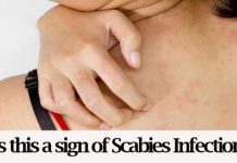 home remedies for scabies