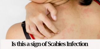 home remedies for scabies