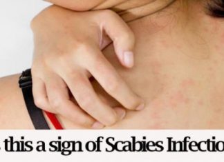 home remedies for scabies