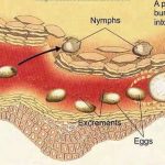 home remedies of scabies