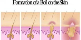 how to get rid of boils