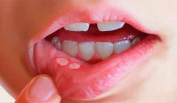 how to get rid of canker sore