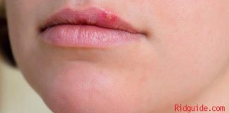 how to get rid of cold sores fast