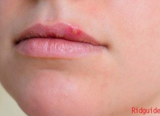 how to get rid of cold sores fast