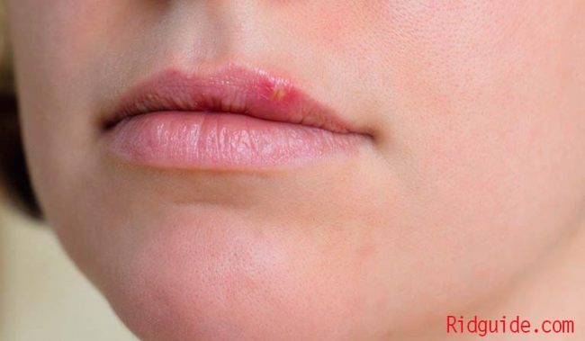 how to get rid of cold sores fast