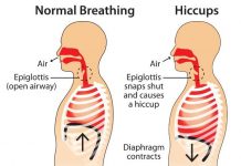 how to get rid of hiccups