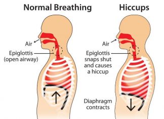 how to get rid of hiccups