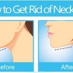 how to get rid of neck fat