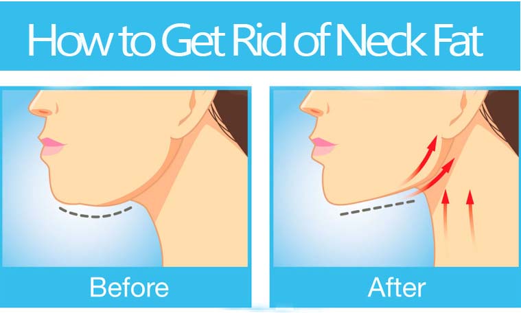 how to get rid of fat neck and face