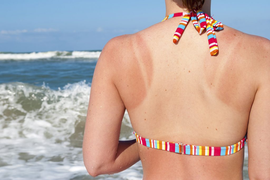 how to treat sunburn