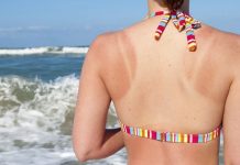 how to treat sunburn