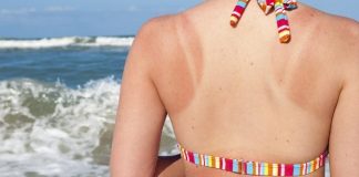 how to treat sunburn