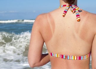 how to treat sunburn