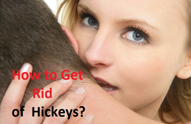 How to Get Rid of Hickies