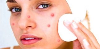 Get Rid of Pimples