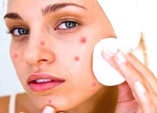 Get Rid of Pimples