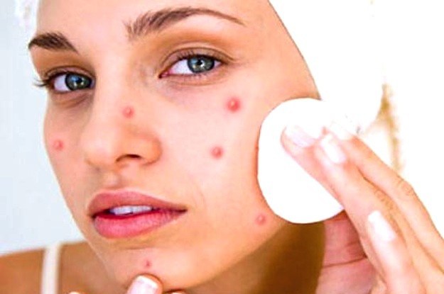 Get Rid of Pimples