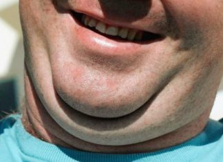 Get Rid of a Double Chin