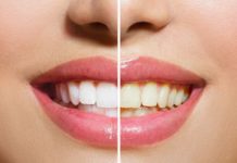 How to Get Whiter Teeth