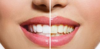 How to Get Whiter Teeth