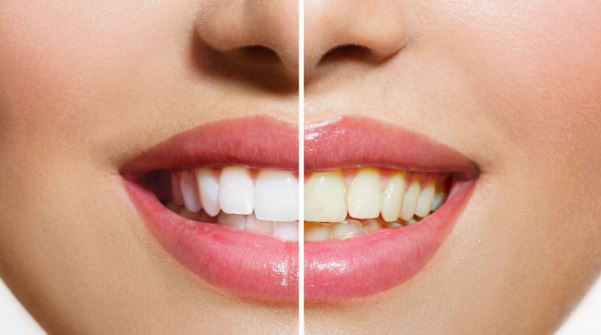 How to Get Whiter Teeth