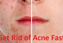 How to prevent acne