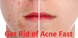 How to prevent acne