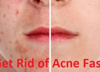 How to prevent acne