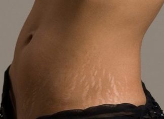 how to prevent stretch marks