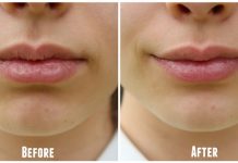 get rid of chapped lips