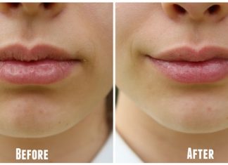 get rid of chapped lips