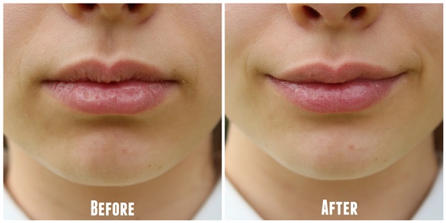 get rid of chapped lips