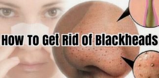 how to get rid of blackheads