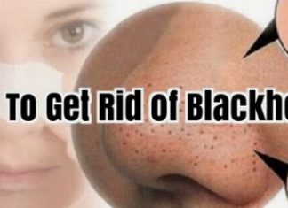 how to get rid of blackheads