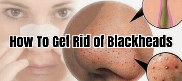 how to get rid of blackheads