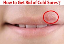 how to get rid of cold sores