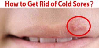 how to get rid of cold sores