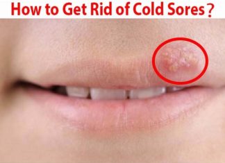 how to get rid of cold sores