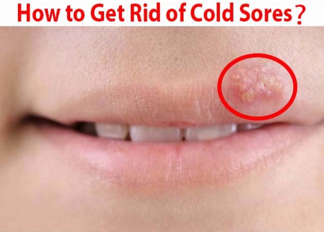 how to get rid of cold sores