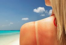 how to get rid of sunburn