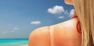 how to get rid of sunburn